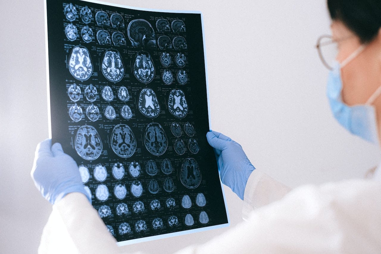 A Doctor Holding an MRI Result of the Brain Showing the Stages of Dementia
